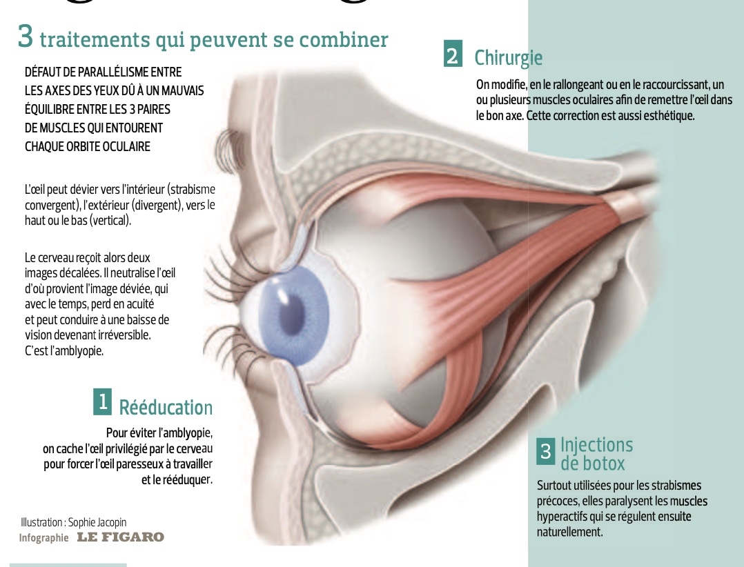 Strabisme: il y a urgence à agir