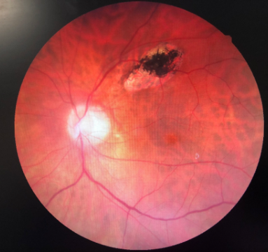 Rétinophotographies
