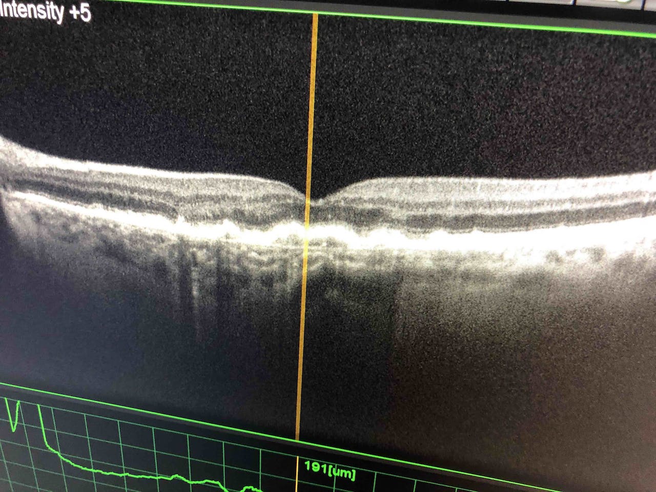 Tomographie par Cohérence Optique